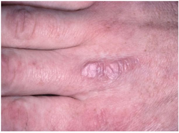 手部水疱 脱屑 还诊断为湿疹 是时候了解这11 种皮肤病了