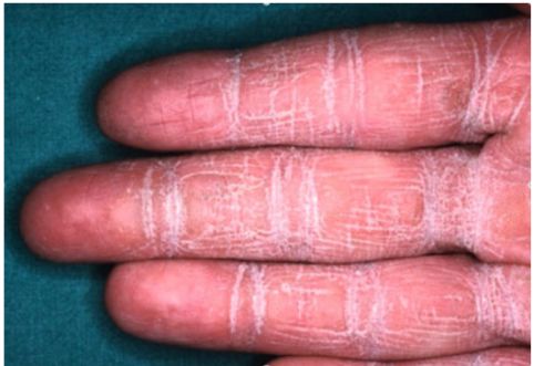 手部水疱、脱屑,还诊断为湿疹?是时候了解这 11 种皮肤病了!