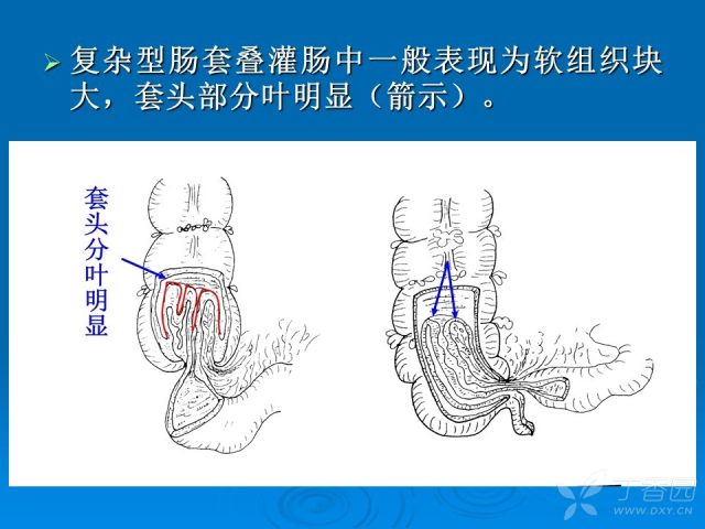 宝宝灌肠的原理是什么_上环是什么原理图片(2)