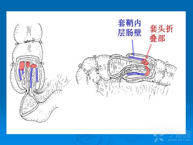 肠套叠原因图片