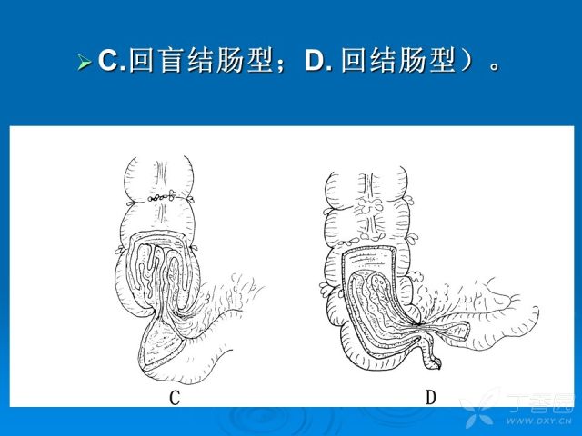 肠套叠原因图片