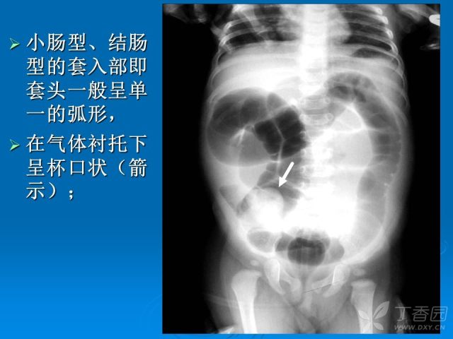 小儿急性肠套叠空气灌肠难整复之征象原因及应对措施