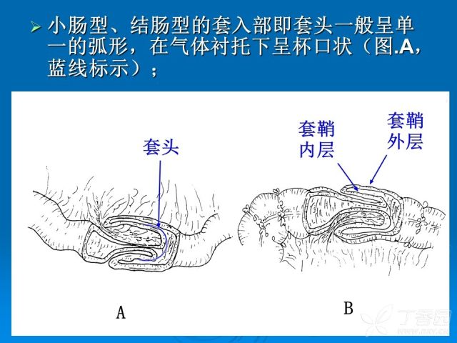 肠套叠原因图片