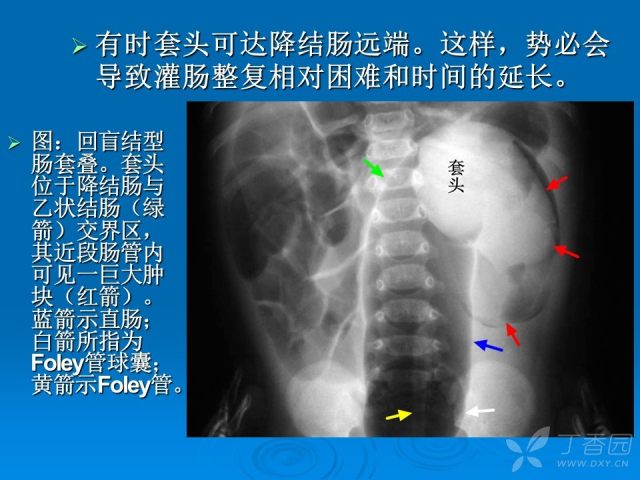 小儿肠套叠的超声图谱图片