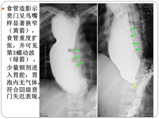 食管癌龛影图片图片