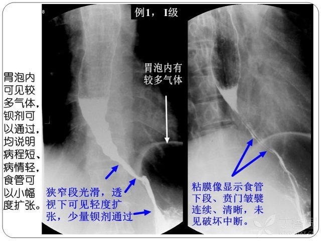 正常食管造影图片图片