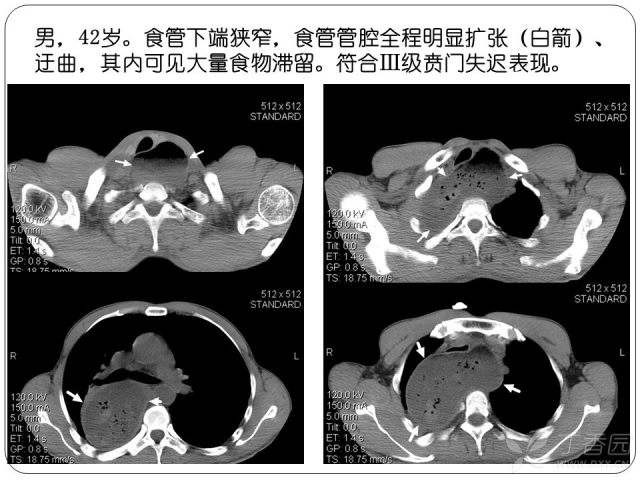 实用干货食管常见病影像诊断之二