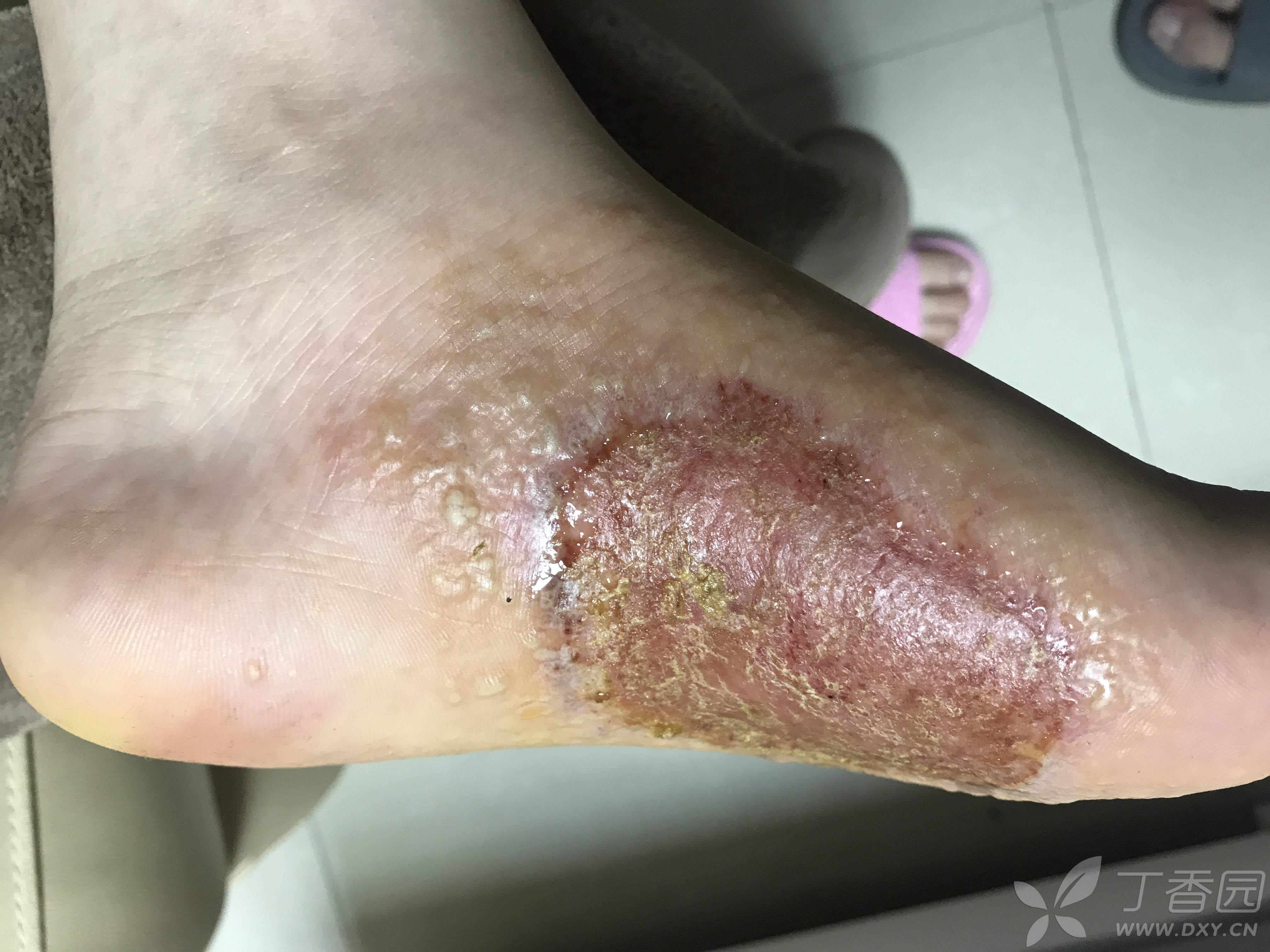 掌跖脓疱病?手足癣?湿疹?求诊断!谢谢
