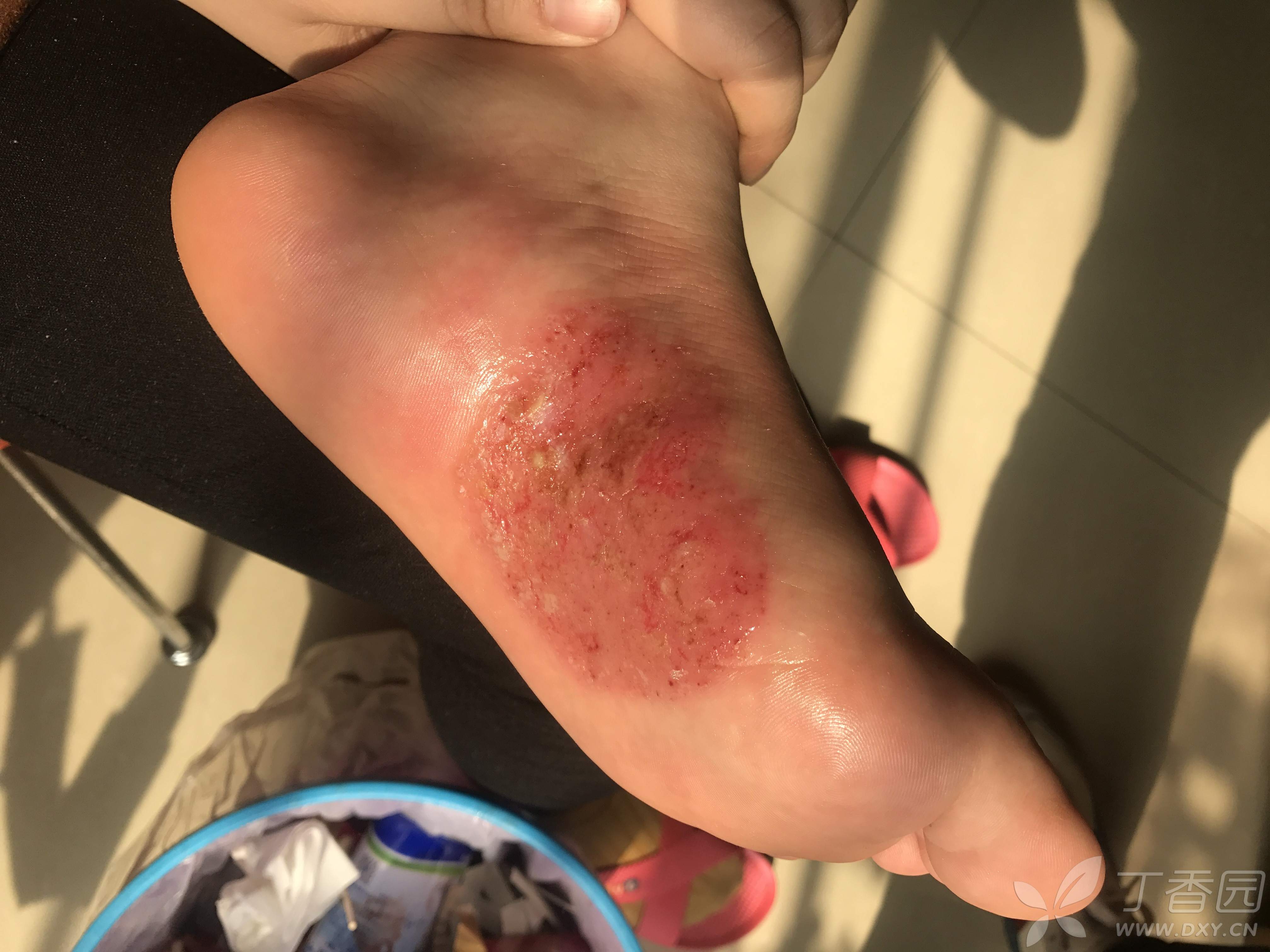 掌跖脓疱病?手足癣?湿疹?求诊断!谢谢