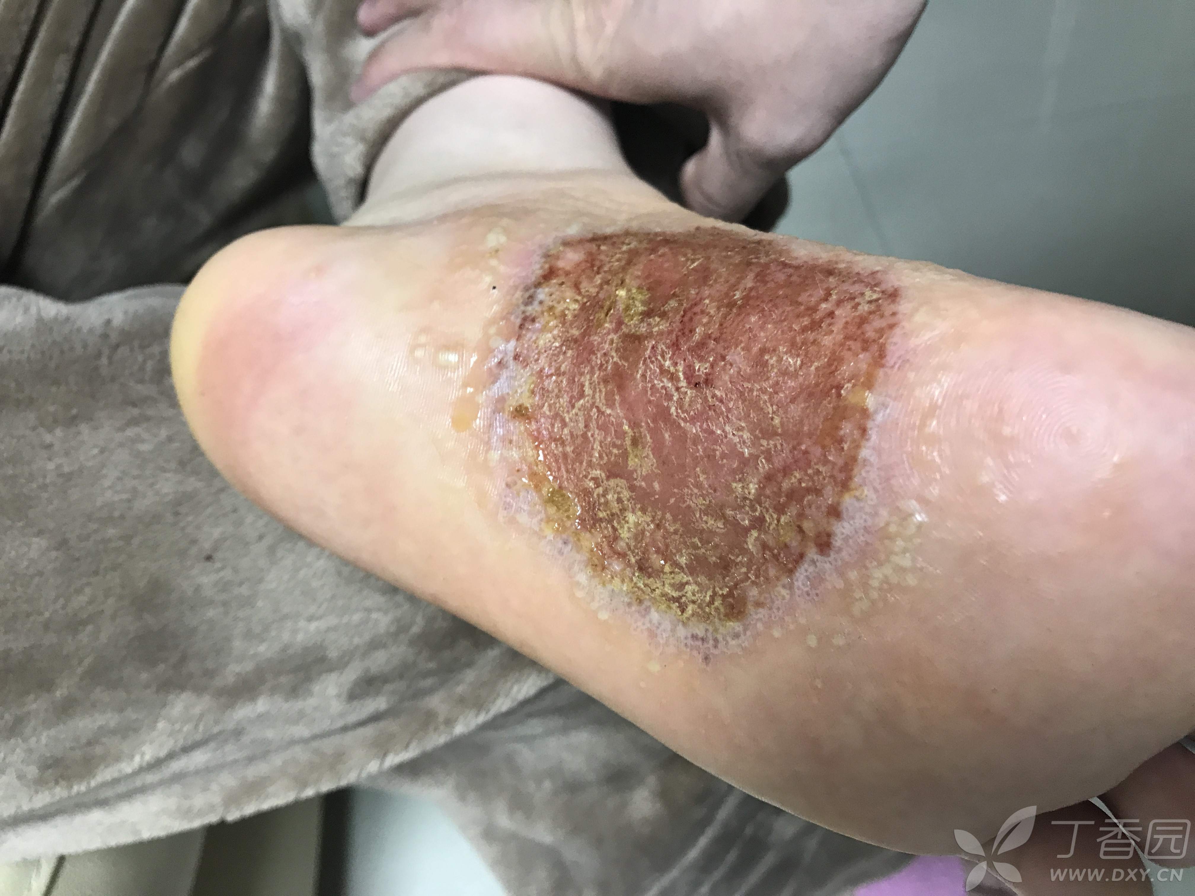 掌跖脓疱病?手足癣?湿疹?求诊断!谢谢