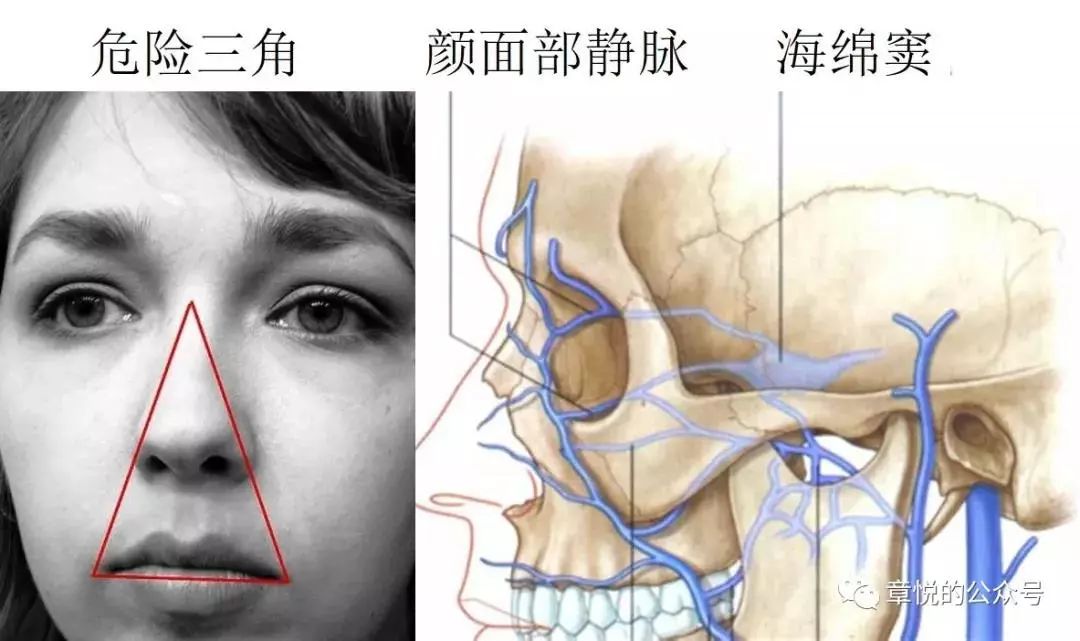 神經科最難啃的骨頭海綿竇綜合症