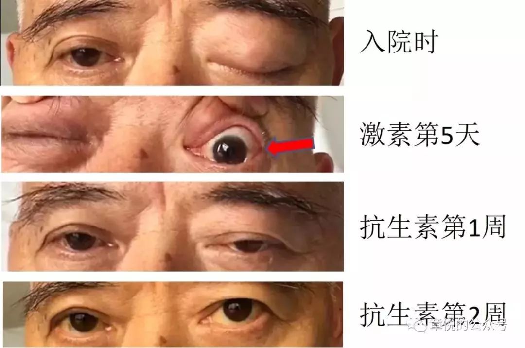 圖 5 箭頭所指為球結膜水腫筆者後記臨床上有一種「有」叫「應該有」