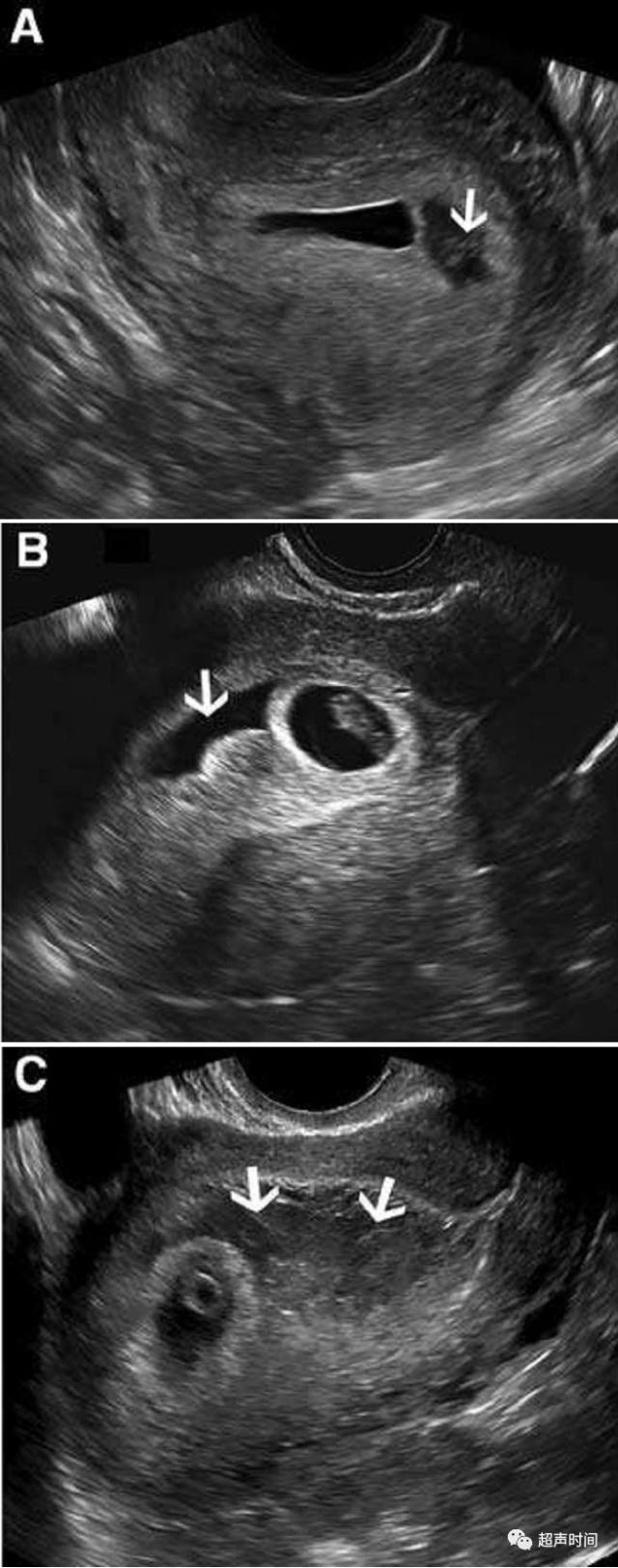孕早期绒毛膜下血肿 超声评估方法和妊娠预后 丁香园