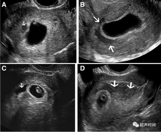 孕早期绒毛膜下血肿 超声评估方法和妊娠预后 丁香园