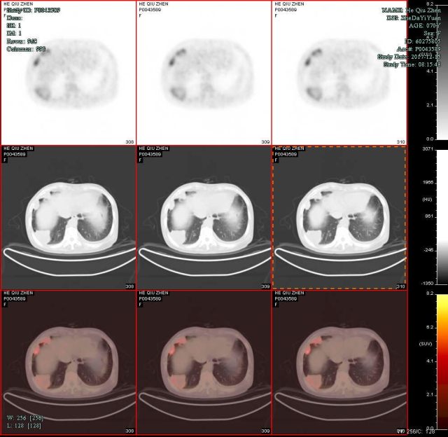 PETCT3.jpg