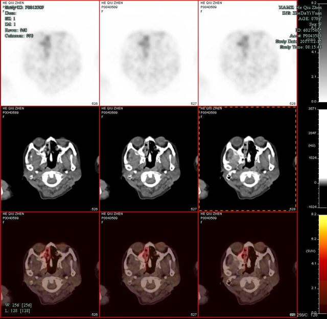 PETCT1.jpg