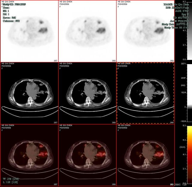 PETCT2.jpg