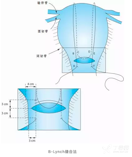 宫颈锥切缝合图解图片