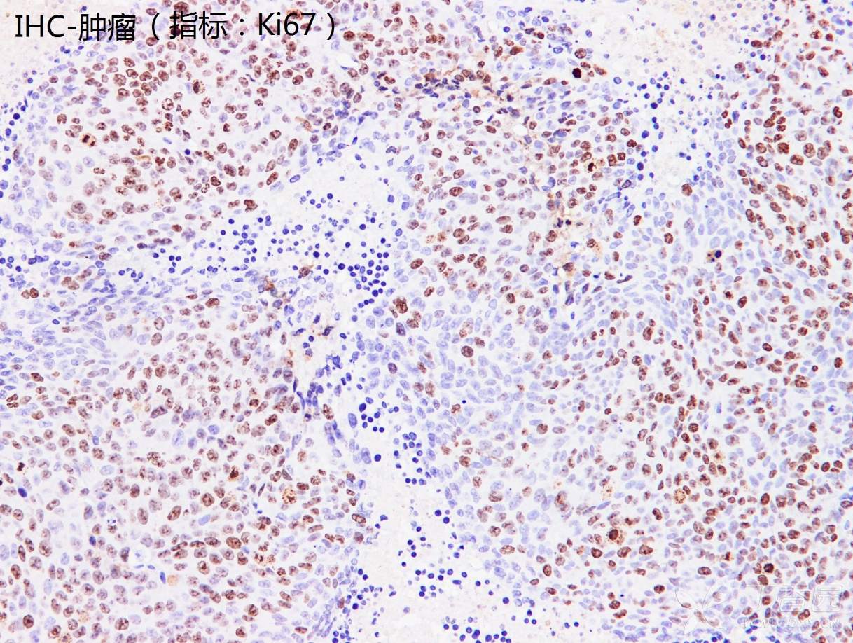 ki67免疫组化图片