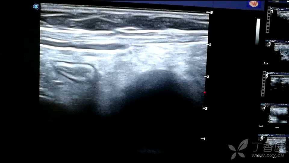 回盲部肿瘤 超声医学讨论版 丁香园论坛