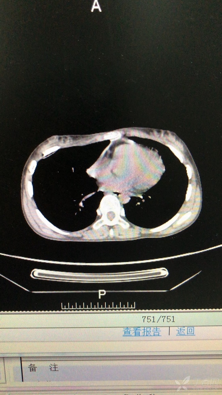真的是被撑死了:急性胃扩张.