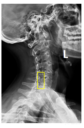 颈椎钩椎关节图片