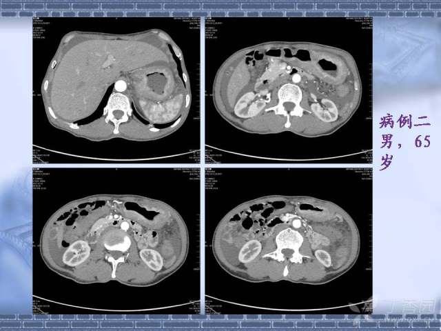 胃癌ct图片 片子图片