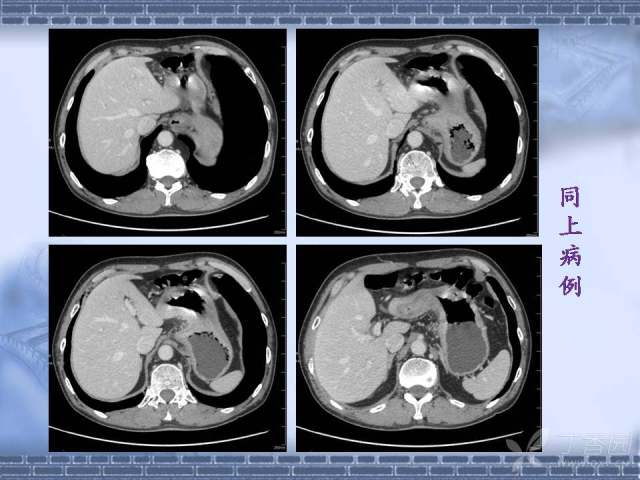 胃癌ct图片 片子图片