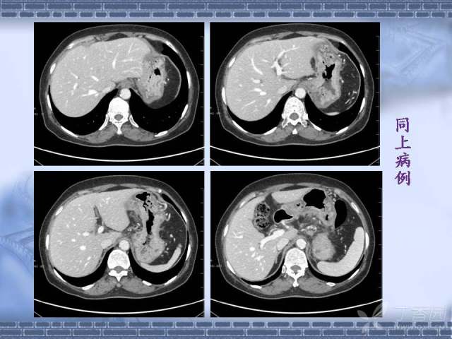 胃癌ct图片 片子图片