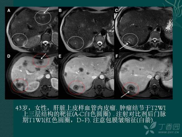 肝血管瘤影像图片