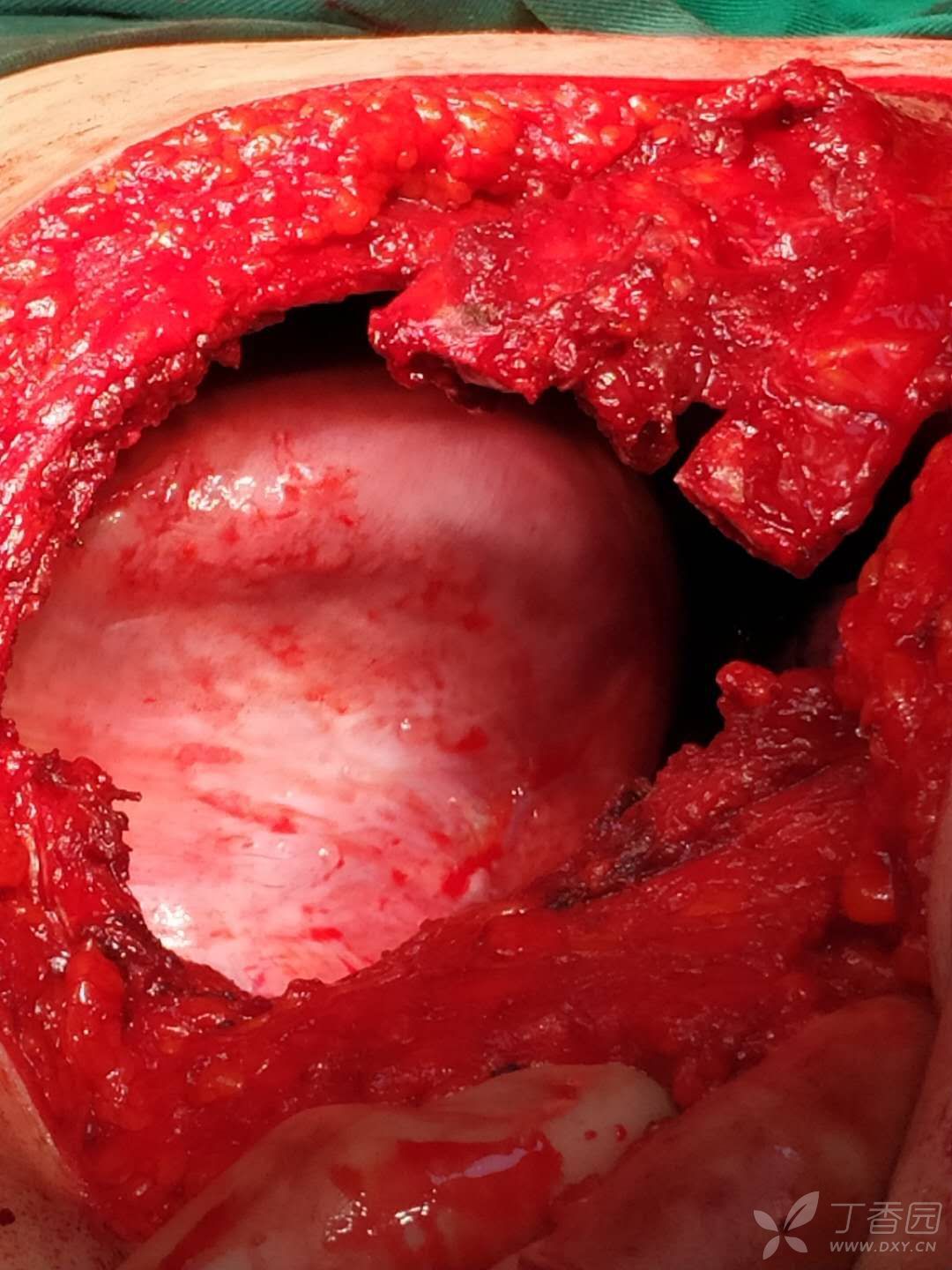 一例少见胸腔软骨肉瘤