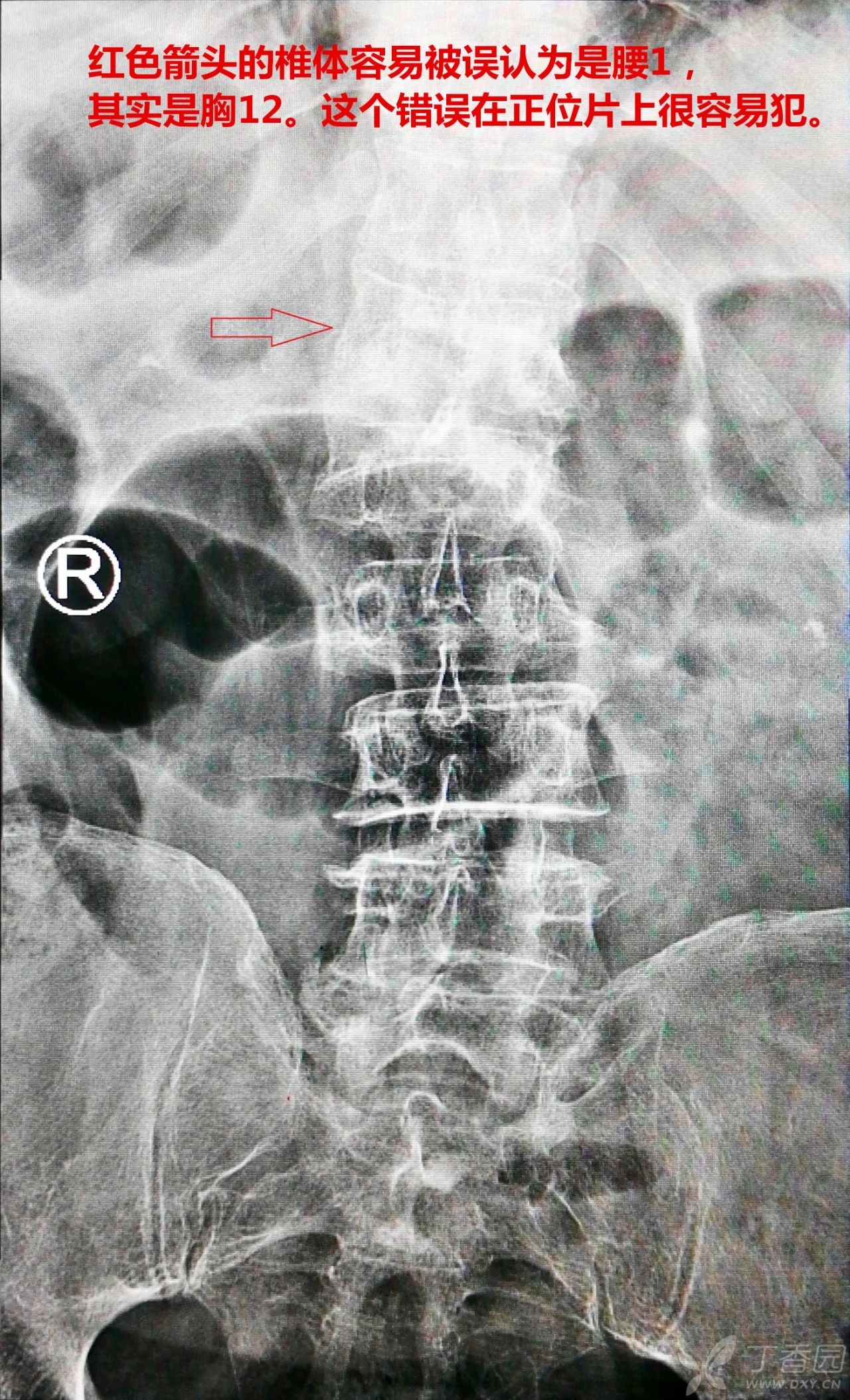 脊柱CT解剖 - 知乎