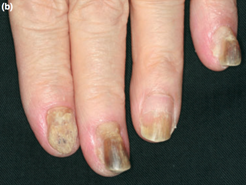 指甲角化过度,开裂,竟然是剥大蒜惹的祸?