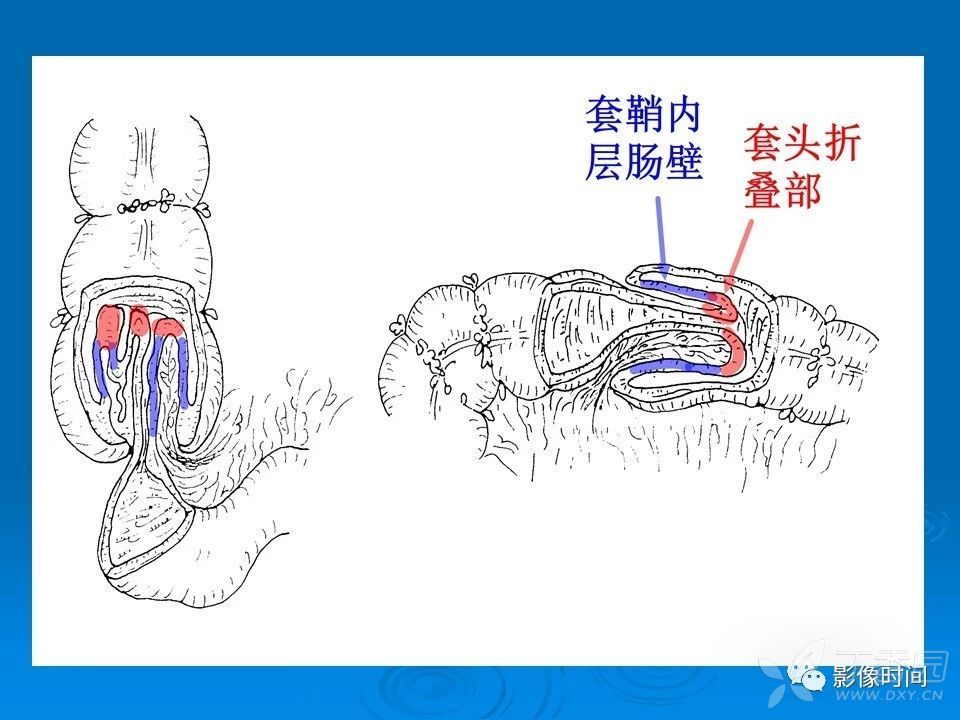 来源:华夏览雄 影像时间 本文重点讨论肠套叠分型,为什么现多用空气