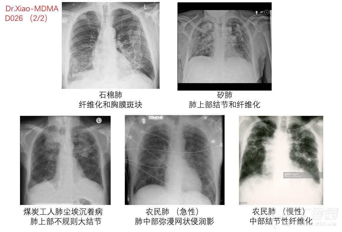 尘肺病人的肺图片
