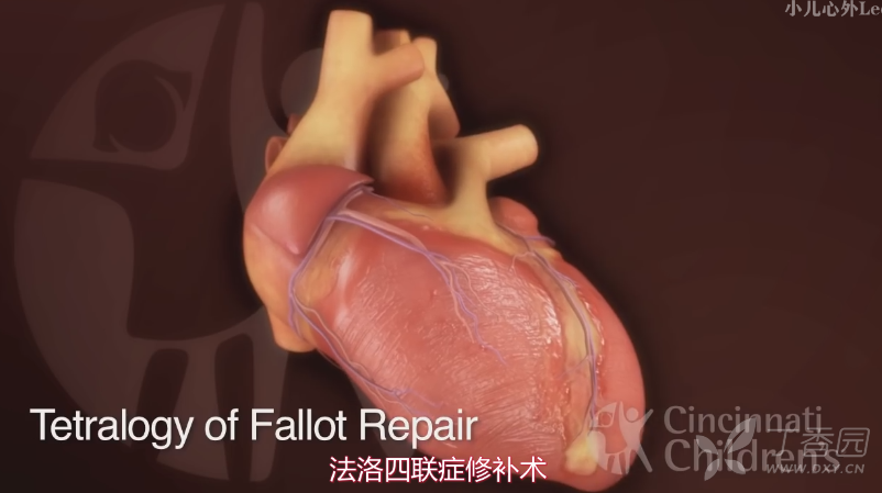 先天性心脏病科普(tof治疗)【第四弹】-法洛四联症治疗