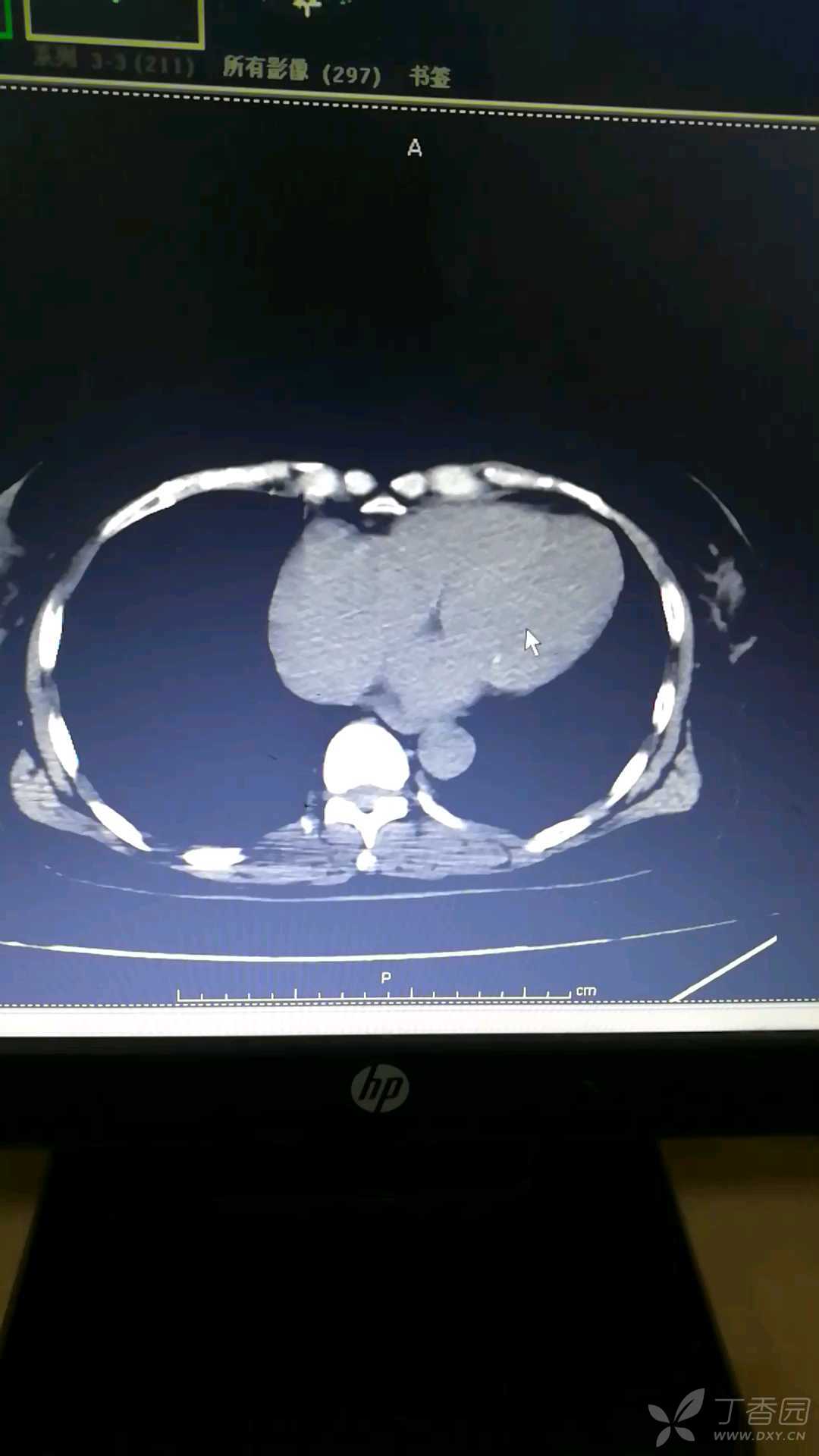 一例口服华法林伴腹壁血肿行成.