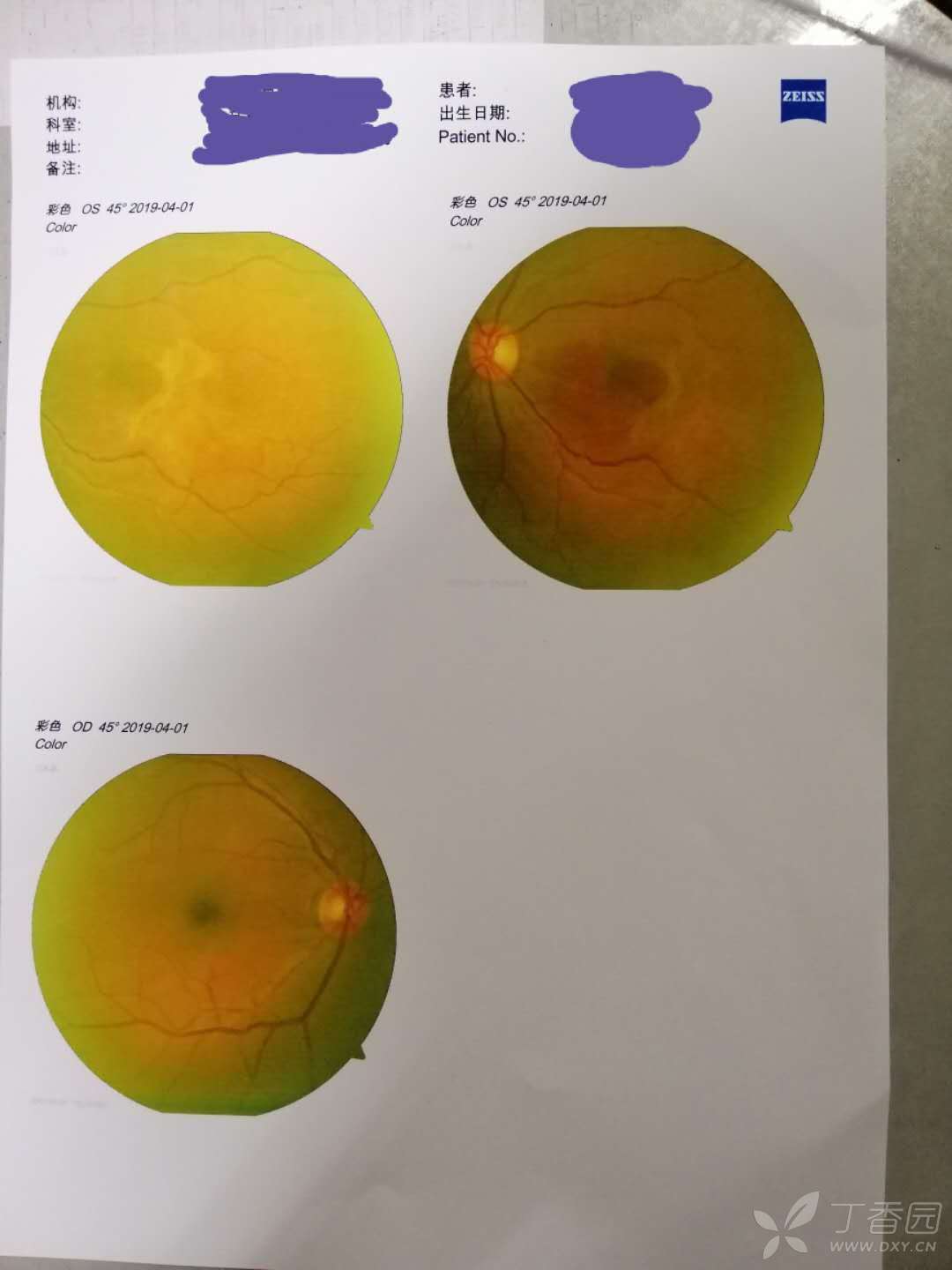 眼角膜kf环图片图片