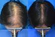 外用非那雄胺/米诺地尔治疗女性型脱发安全有效