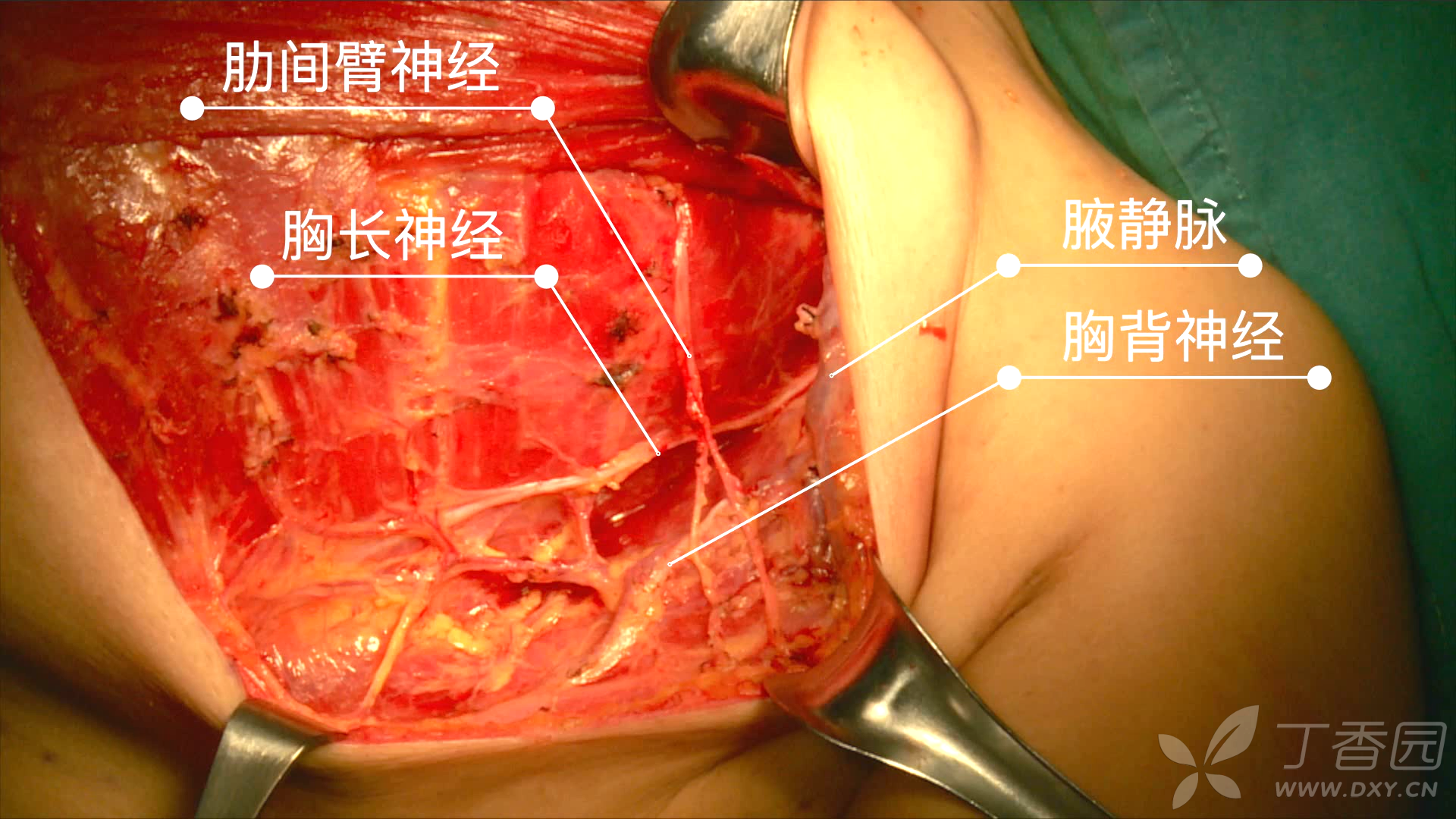 本视频是--2018年全国中青年乳腺癌手术视频大赛（常规组）第一名，参赛选手是--重庆西南医院--梁燕，分享给大家学习，喜欢的给点个赞。 