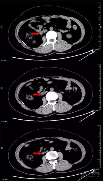 腹部 ct 显示胃小弯侧异物延续至胰腺颈体部