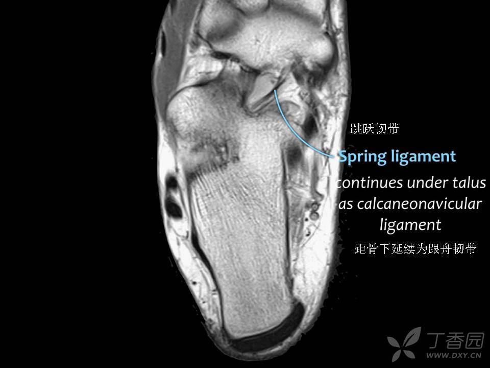 距腓前韧带MRI图片