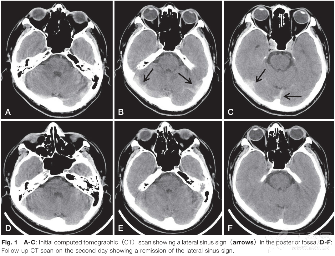 头颅ct静脉窦高密度除了静脉窦血栓形成,还有什么? [病例帖]