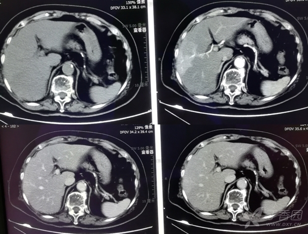 肝右叶CT图片
