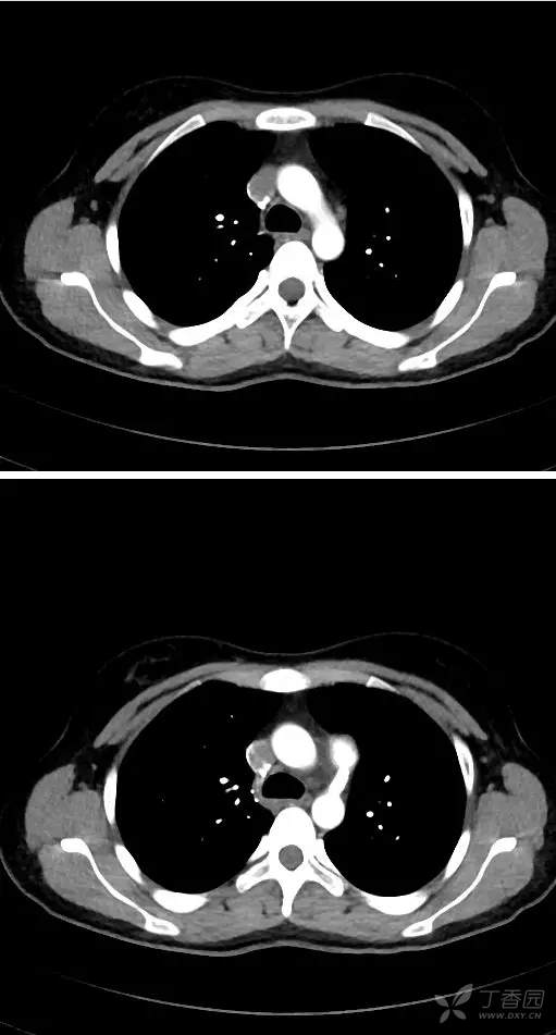 ct看少见病:5分钟学会ct看先心病--动脉导管未闭.