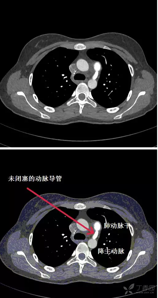 动脉导管未闭胸片图片