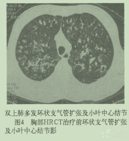 支气管痰栓,气管支气管,空气支气管征(第4页)_大山谷图库