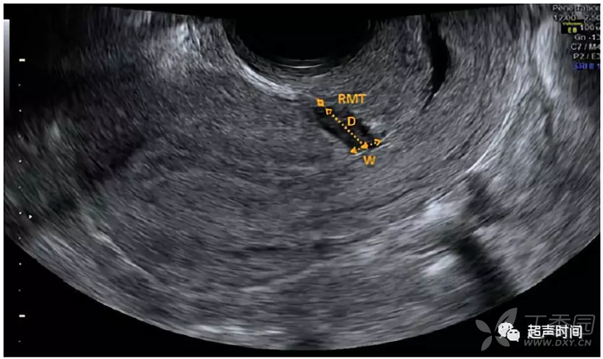 子宫憩室图片 彩超图片