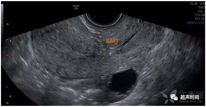 子宫憩室图片 彩超图片
