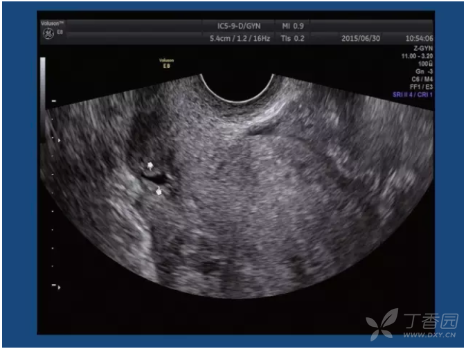 高手进阶:剖宫产子宫切口憩室的超声表现